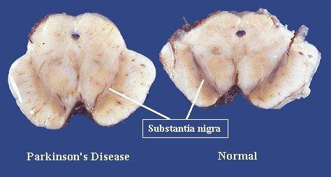 Parkinson s Disease The cause of Parkinson s disease is a degeneration of dopaminergic neurons in the substantia nigra pars