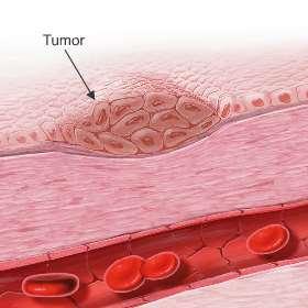 A benign tumor is noncancerous. It does not spread to surrounding healthy tissue. A malignant tumor is cancerous.
