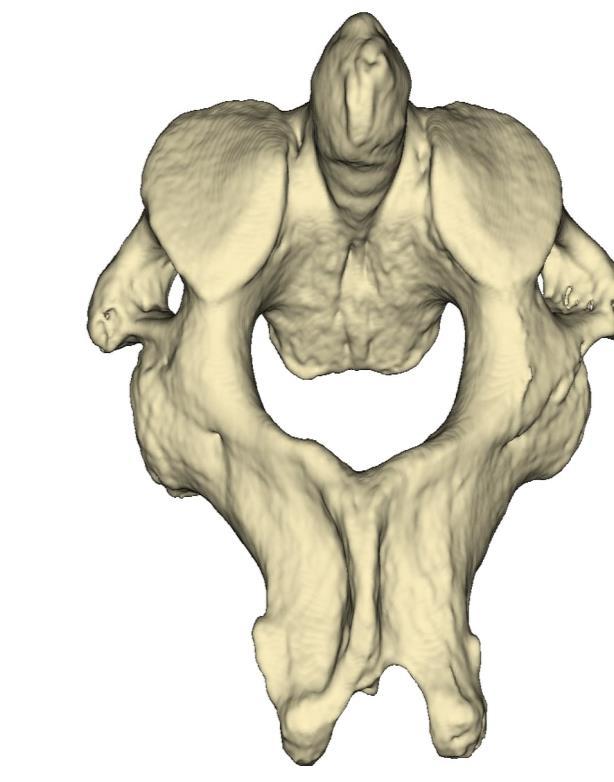 Axis Atlanto-axial rotation is free because of the lack of an articular process and intervertebral