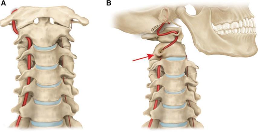 Vertebrobasilar artery insufficiency (VBAI) Cervical rotation testing affected contralateral vertebral artery flow but did not