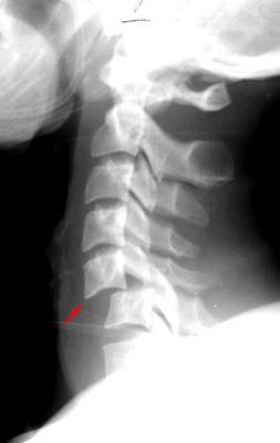 Imaging MRI is indicated for complex cervical radiculopathy (Bono et al.