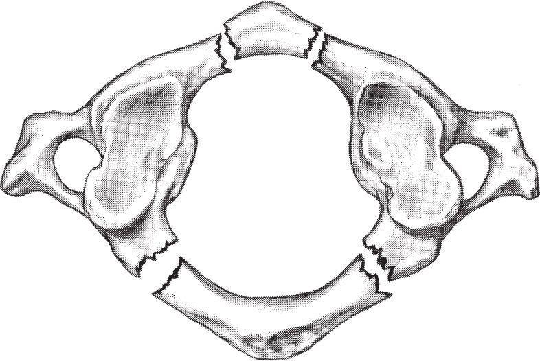 Atlas Ring shaped with no vertebral body Weight of head carried by lateral masses Anterior arch : longus colli attaches to the