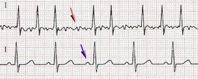 normal regular electrical impulses of the atria are