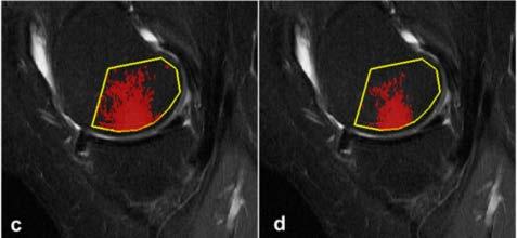 New methodologies facilitate development of disease modifiers Improved magnetic resonance imaging