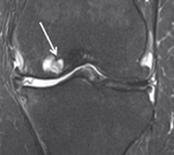 mg or 200 mg once daily against a placebo The key objectives are to assess the effect of six months of treatment on knee joint clinical pain and on knee OA, assessed using magnetic resonance imaging,