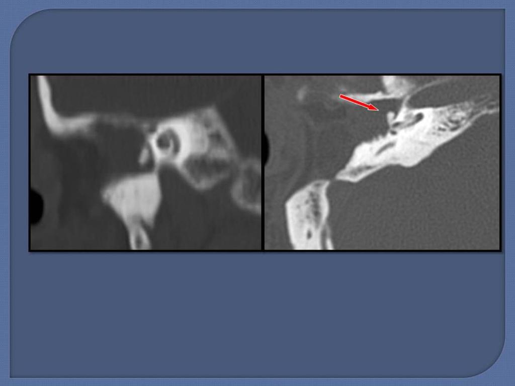 Fig. 4: CT reconstructions right ear with axial, coronal, with bone window.