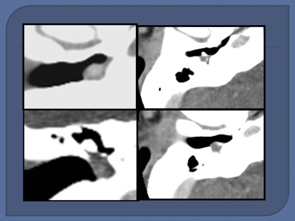 Fig. 6: CT reconstructions right ear with