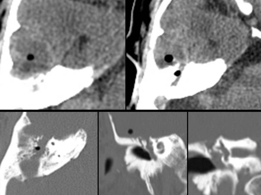 Fig. 9: CT with IV contrast right ear with axial plane reconstruction with bone window and soft.