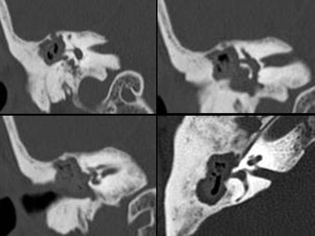 Fig. 2: CT reconstructions right ear with axial, coronal, with bone window.