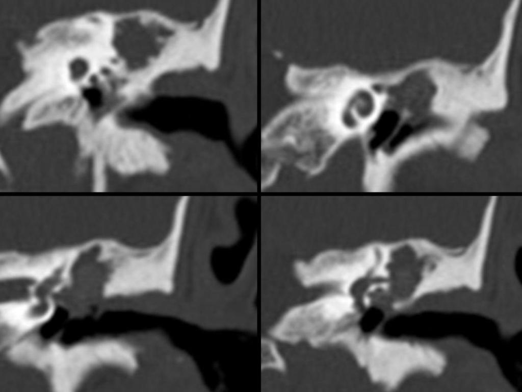 Fig. 3: TC left ear reconstructions in axial, coronal, with bone window.