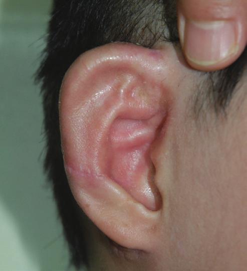 The earliest 8 patients underwent ear reconstruction using a costal cartilage framework without a conchal bowl element and the latter 12 patients with a conchal bowl element.