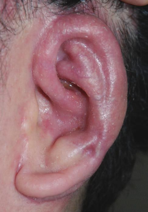 The reconstructed ear 15 months after the operation showed a relatively acceptable outcome, but the shallow depth of the cymba compared to cavum concha should be noted (Fig. 7).