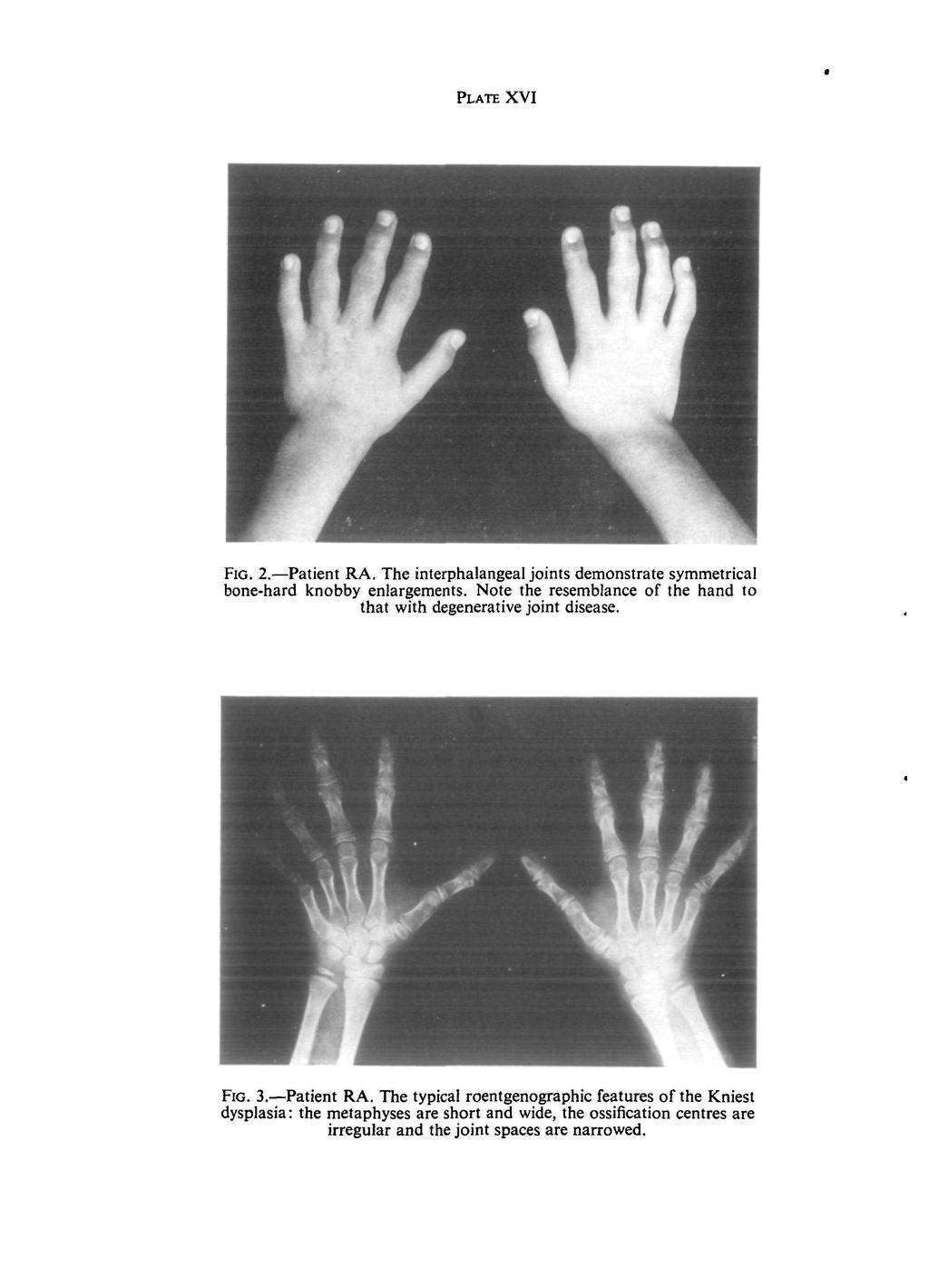 PLATE XVI FIG. 2. Patient RA. The interphalangeal joints demonstrate symmetrical bone-hard knobby enlargements. Note the resemblance of the hand to that with degenerative joint disease.