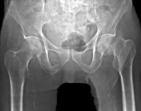 2/8/2017 EXPANDING THE FEAR: HIP FRACTURES Only 25% will make a full recovery 40%