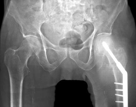 the age of 50 will die within 12 months of suffering a hip fracture.