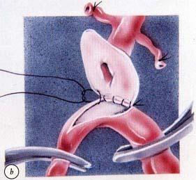 A variation of this is to anastomosis the donor coeliac trunk with an aortic patch to the recipient s common hepatic
