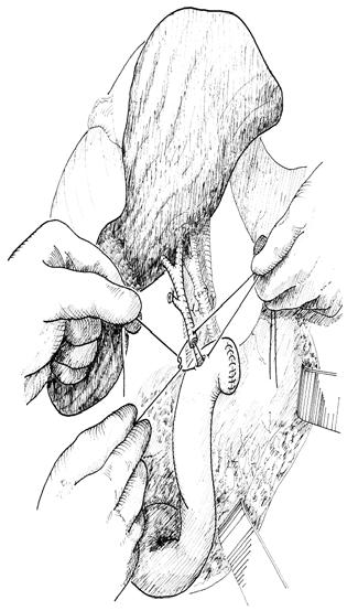 BILE DUCT ANASTOMOTIC TECHNIQUES Technique has become standardised cholecystectomy routinely performed cholecystojejunostomy or