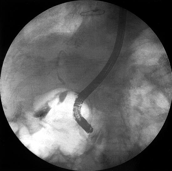 BILE DUCT COMPLICATIONS: MANAGEMENT OF BILARY LEAKS Small leaks can be managed endoscopically or radiologically by placing a temporary stent Larger leaks or disruption of the anastomosis should be