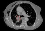 Men HU in Region A Effect of Inhomogeneous HU between CT/CBCT Rdiomics feture vritions on CBCT nd plnning CT Hrmoniztion between plnning CT (pct) nd on-bord CBCT imges Plnning CT A 15 Lung SBRT