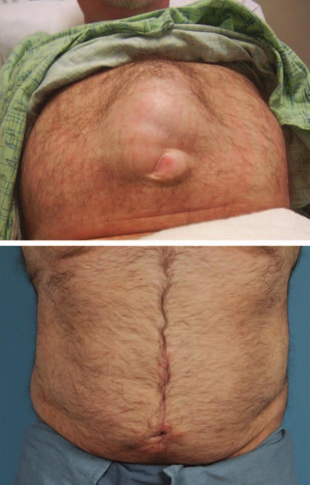 Volume 135, Number 1 Management of Severe Rectus Diastasis setting of large intraabdominal fat volume or male pattern rectus diastasis and therefore recommend against repair.