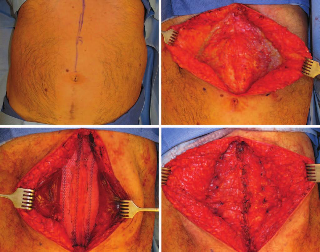 Plastic and Reconstructive Surgery January 2015 Fig. 3. Male patient undergoing epigastric rectus diastasis repair with retrorectus mesh placement.