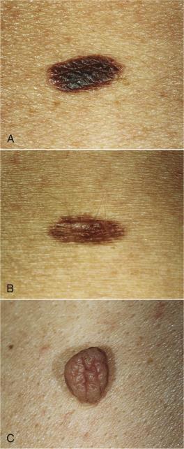 Skin Lesion Description Good description includes: Number Size Color Shape Texture Primary lesion Location Configuration
