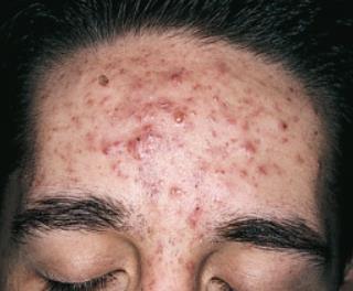 Acne Vulgaris Signs and Symptoms Mild Acne Moderate Acne Severe Acne Seidel's Guide to Physical Examination.