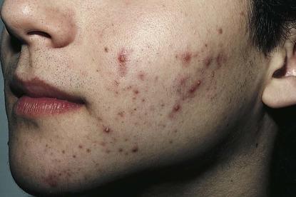 Acne Plan Keep face clean and dry Mild Form Moderate Form Severe Form The Skin Textbook of Physical Diagnosis.