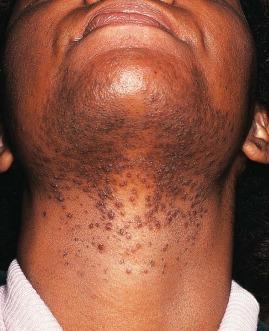 Folliculitis (Cont.) Signs and Symptoms Folliculitis Furuncles Carbuncle Folliculitis Dermatology Essentials. Published January 1, 2014. Pages 268-282. 2014. Fig. 31.