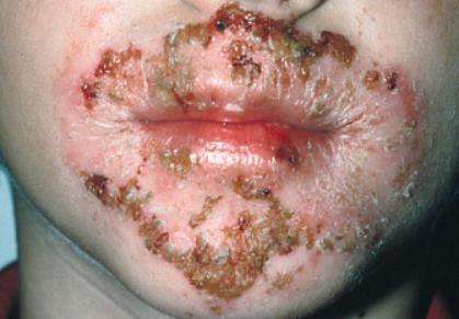 Impetigo Signs and Symptoms Starts as a small papule Progresses into eroded vesicles Honey-colored crusted plaques" with erythematous