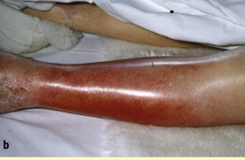 Signs and Symptoms Large, well-defined area of erythema Edema and pain with touch The appearance and texture is that of an orange peel