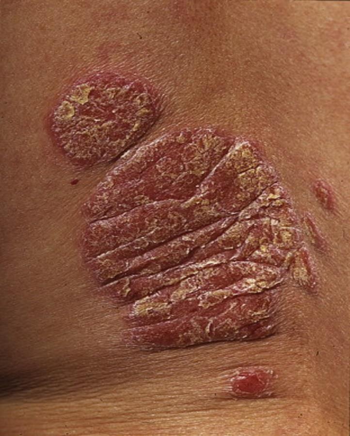 Psoriasis Plan Mild Steroid cream & sun bathing Moderate Topical steroid Severe Dermatologic consultation Psoriasis Clinical Overview.