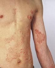 Tinea Infections Signs and Symptoms Findings range from mild scaling and erythema to exfoliation, fissuring and maceration.
