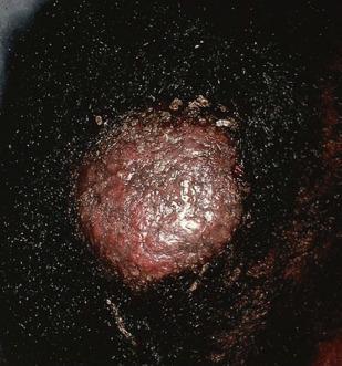 Tinea Capitis & Tinea Corporis Signs and Symptoms Tinea Capitis Evaluation and Management of the Hair Loss Patient in the Primary Care Setting