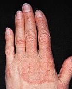 Tinea Manus Signs and Symptoms Tinea Manus Usually in the dominant hand of a patient Fungal Infections Skin Disease: