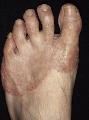 Tinea Pedis Signs and Symptoms Tinea Pedis Intensely pruritic May look like annular lesions with an advancing serpinginous borders with central clearing