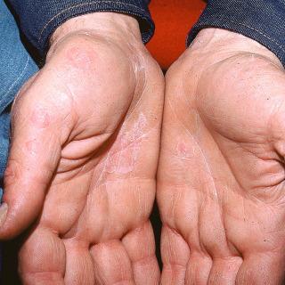 Tinea Plan Topical antifungals Oral antifungals Foot powder Hygiene practices Dermatitis (Eczematoid Reactions) Urgent Care