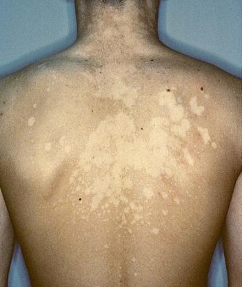 Tinea Versicolor Plan Selsun shampoo Educate patient If no resolution The Skin Textbook of Physical