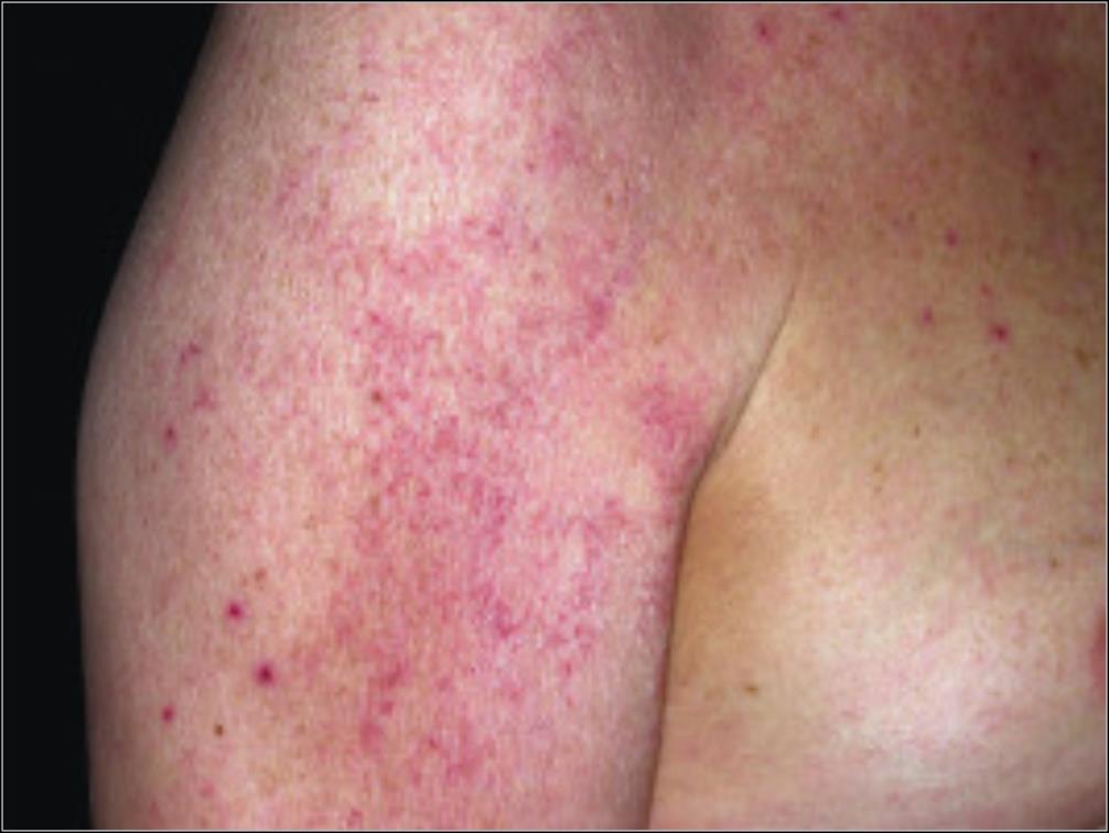 Eczema Signs and Symptoms Eczematous inflammation Redness, scaling, vesicles and itching Eczema Skin Disease: