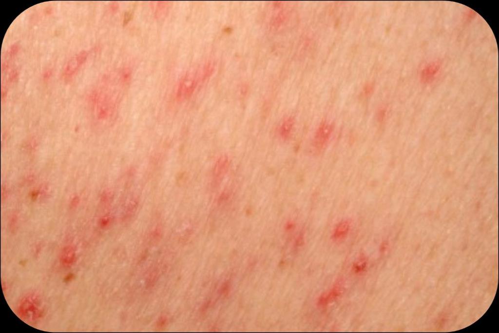 Contact Dermatitis Plan Antihistamines Wash the exposed area with soap and water Topical medications Instruct patient to avoid