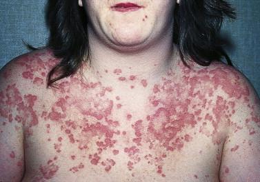 Urticaria Signs and Symptoms Generalized distribution of well circumscribed wheals with red, raised borders May be the first sign of Anaphylaxis