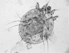 Scabies Signs and Symptoms May not appear up to a month Gray brown or skin colored ridges Secondary bacterial