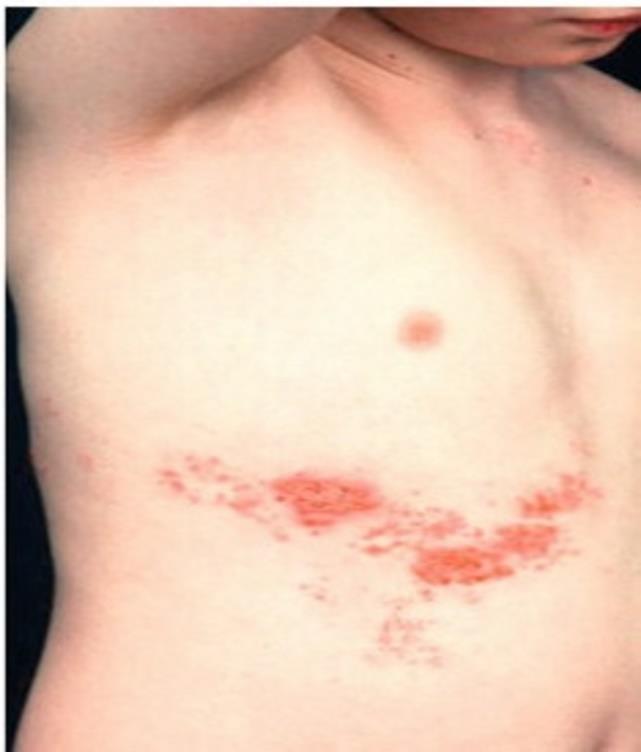 Shingles (Herpes Zoster) Signs and Symptoms Prodromal Phase Tingling, paresthesias Itching Boring "knife-like" pain Acute Phase
