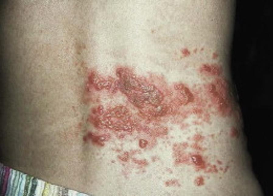Herpes Zoster Plan Antiviral agents Warn of potential risk of transmitting illness Herpes zoster