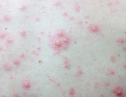 Chickenpox Signs and Symptoms Rash Pruritic rash present in various stages Lesions may be present