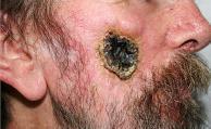 Cell Carcinoma (SCC) Melanoma Results of the