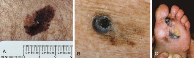 Malignant Melanoma Deadliest ABCDE of Melanoma Clinical and dermoscopic characterization of pediatric