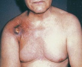 Skin Cancers Plan Referral to Dermatology is required for positive findings Skin Cancer Atlas of