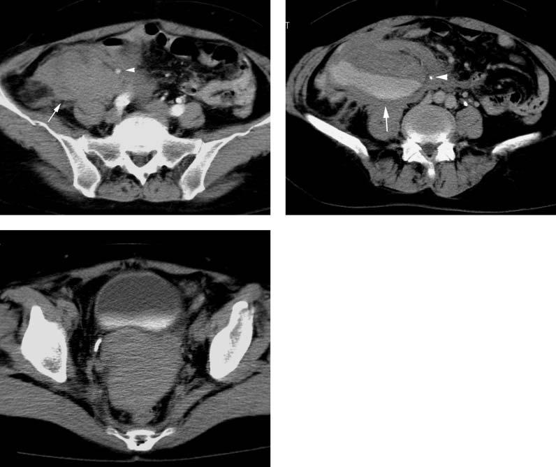 888 M. Nakajo et al. A B C Figure 1. A C. Arterial (A) and venous (B) phase contrast-enhanced CT images obtained at onset.