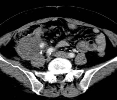 Discussion Spontaneous Retroperitoneal Hemorrhage 889 Fig. 2. Arterial phase contrast-enhancement CT image obtained after 30 days from onset.